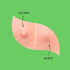 Fundamentals - Get the Zit Out Holographic