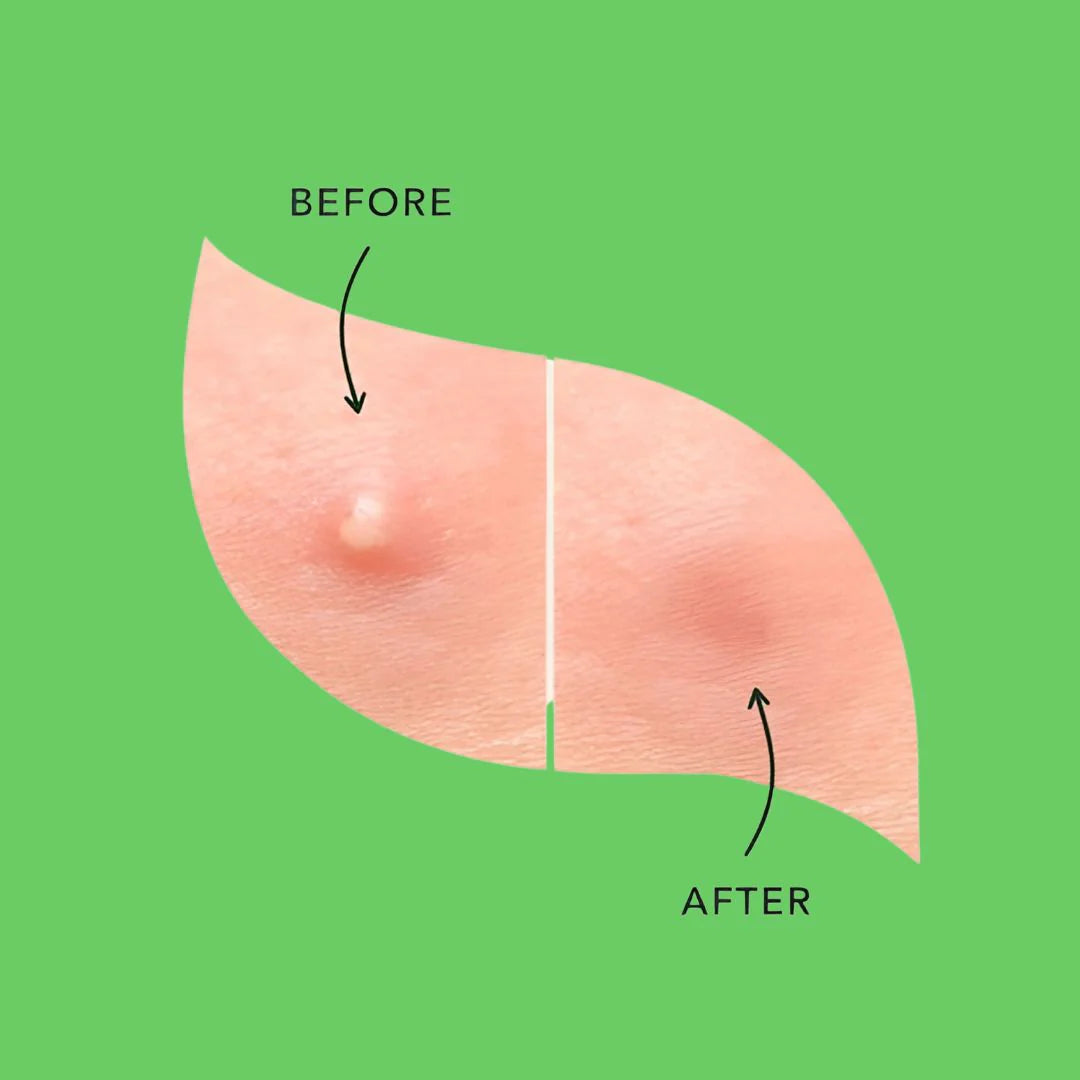 Fundamentals - Get the Zit Out Holographic